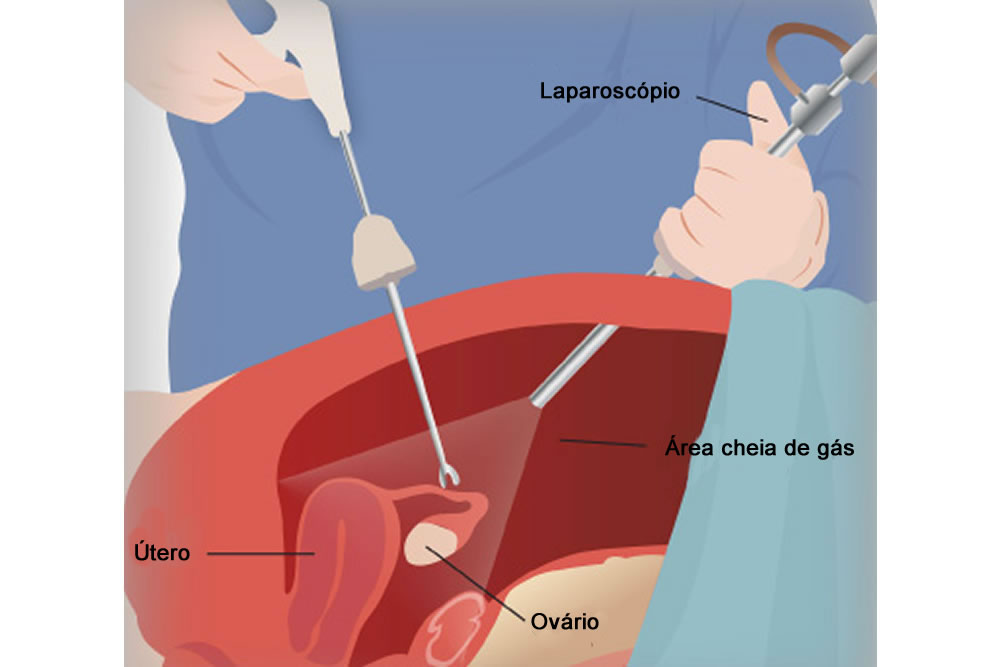 Endoscopia Ginecológica